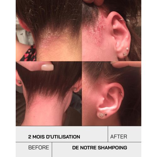 Shampoing Touche Psoriasis Anti Pelliculaire 250 ML