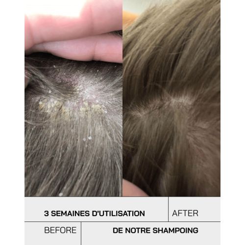 Shampoing Touche Psoriasis Anti Pelliculaire 250 ML