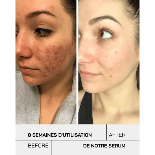 Serum Touche Anti-acne 30 ML